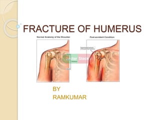 FRACTURE OF HUMERUS
BY
RAMKUMAR
 