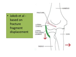 Fracture of lateral humeral condyle | PPTX