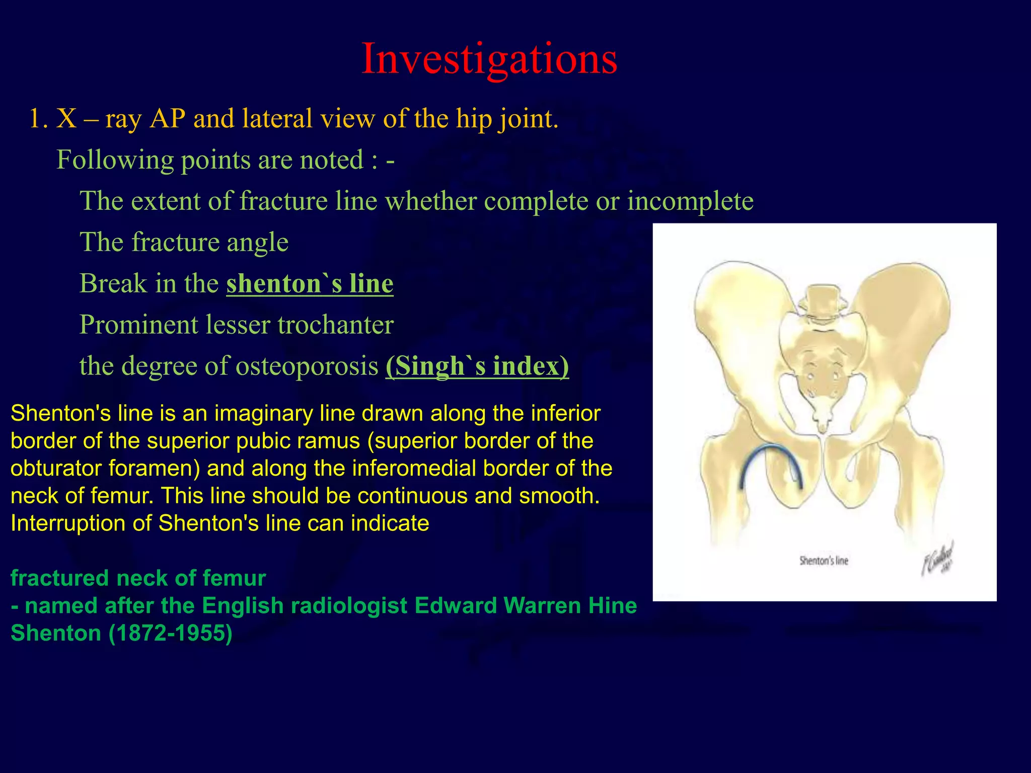 Shenton Line Fracture of neck of femur | PPT