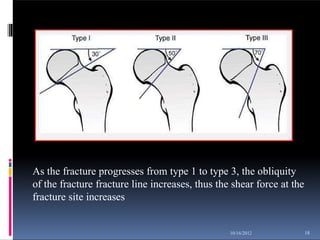 As the fracture progresses from type 1 to type 3, the obliquity
of the fracture fracture line increases, thus the shear force at the
fracture site increases
18
10/16/2012
 