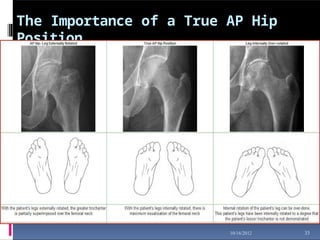 The Importance of a True AP Hip
Position
33
10/16/2012
 