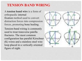 A tension band wire is a form of
orthopaedic internal
fixation method used to convert
distraction forces into compression
forces, promoting bone healing.
Tension-band wiring is commonly
used to treat transverse patella
fractures. The most common
configuration has parallel Kirschner
(K) wires and a stainless steel wire
loop placed in a vertically oriented
figure of eight.
 