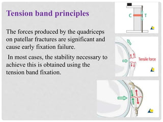 Tension band principles
The forces produced by the quadriceps
on patellar fractures are significant and
cause early fixation failure.
In most cases, the stability necessary to
achieve this is obtained using the
tension band fixation.
 