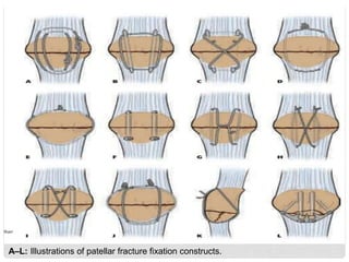 A–L: Illustrations of patellar fracture fixation constructs.
 