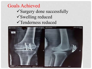 Surgery done successfully
Swelling reduced
Tenderness reduced
 