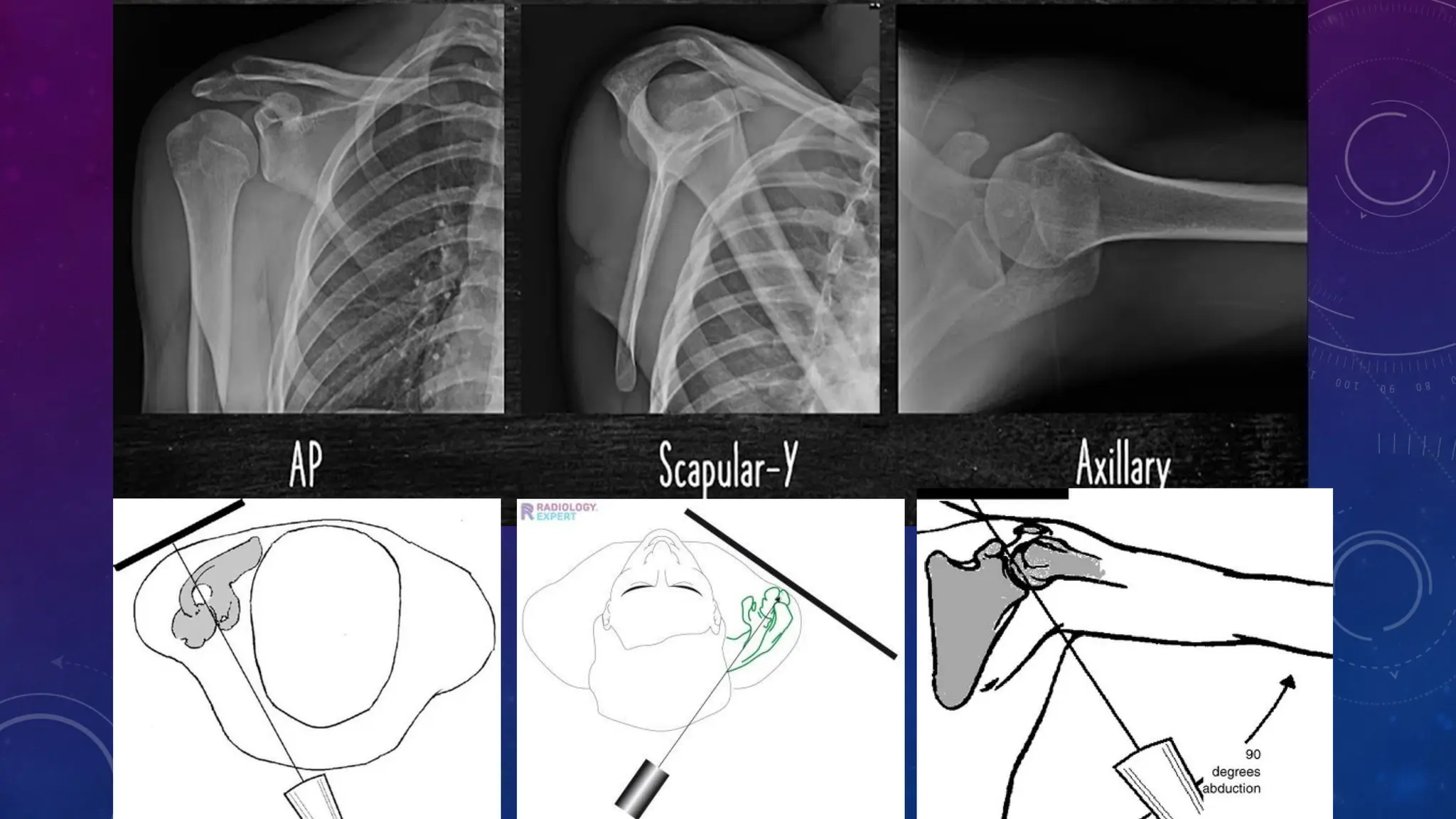 FRACTURE OF PROXIMAL HUMERUS- Etiopathogenesis , clinical features and ...