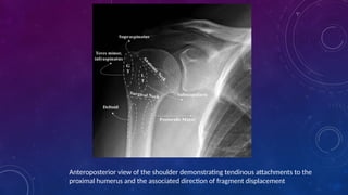 FRACTURE OF PROXIMAL HUMERUS- Etiopathogenesis , clinical features and ...