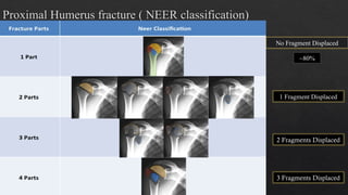 Nehr Classification Fracture of proximal humerus by Dr Prashant KH.pptx
