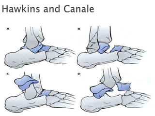 Talus Slides Fracture of talus ppt | PPTX
