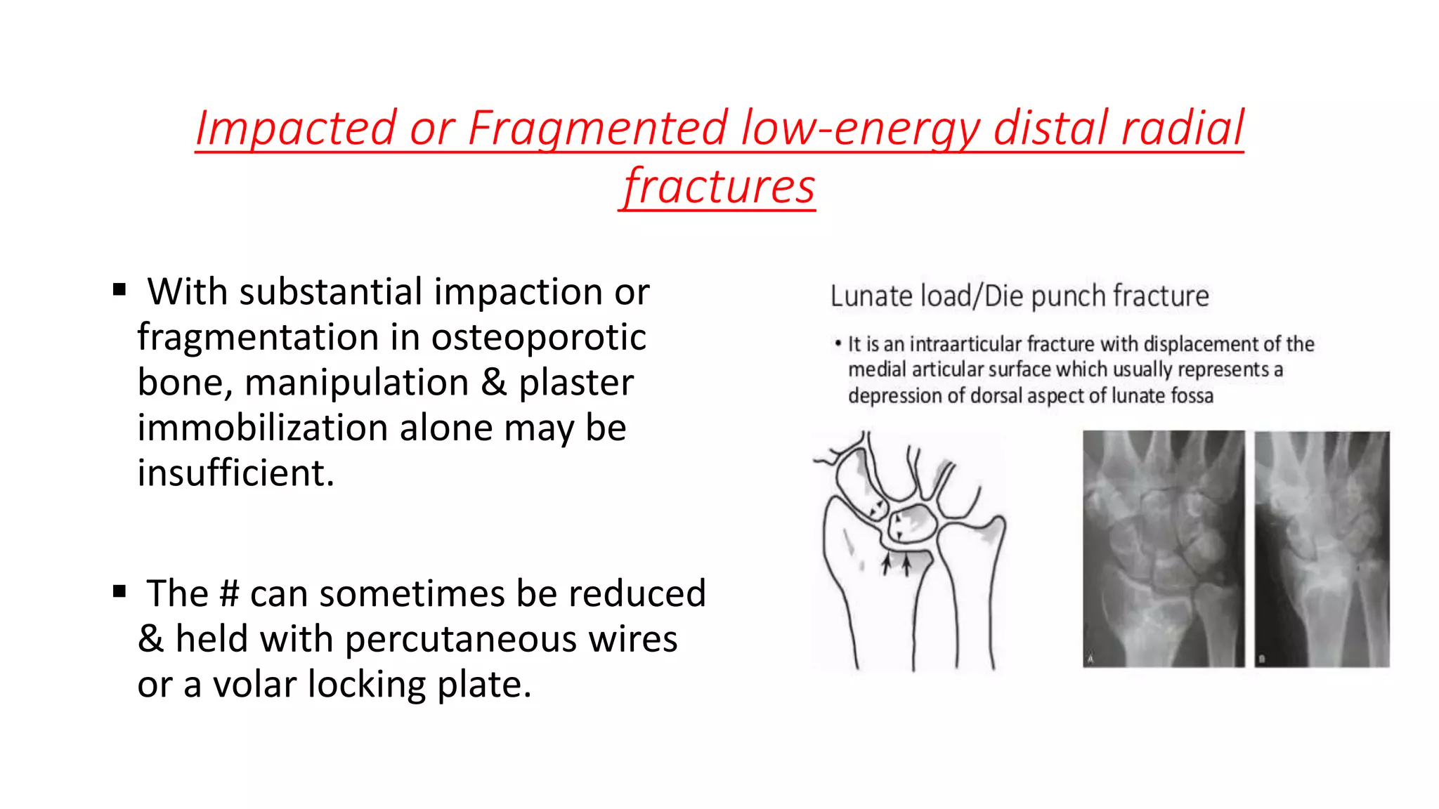 Impacted or Fragmented low-energy distal radial
fractures
 With substantial impaction or
fragmentation in osteoporotic
bone, manipulation & plaster
immobilization alone may be
insufficient.
 The # can sometimes be reduced
& held with percutaneous wires
or a volar locking plate.
 