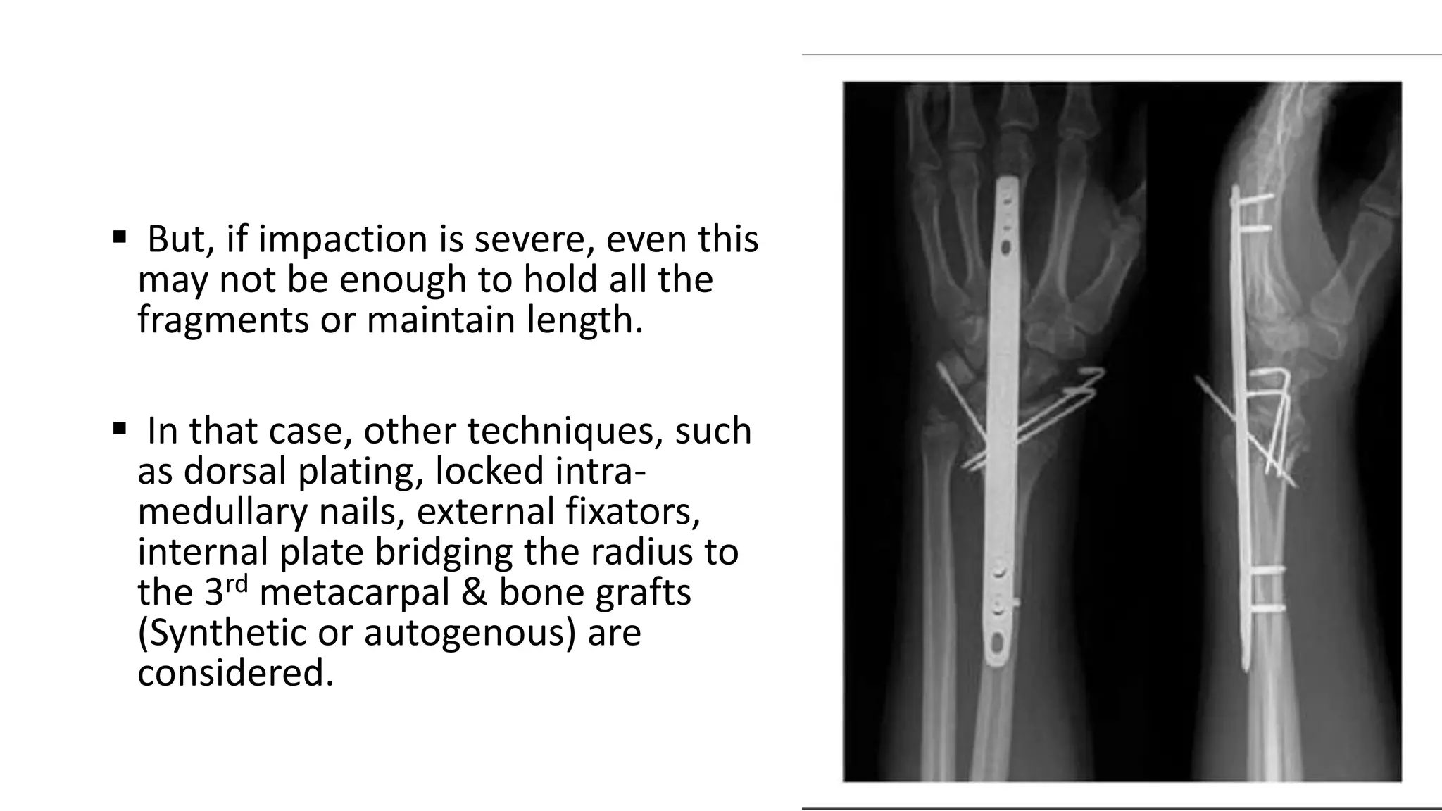  But, if impaction is severe, even this
may not be enough to hold all the
fragments or maintain length.
 In that case, other techniques, such
as dorsal plating, locked intra-
medullary nails, external fixators,
internal plate bridging the radius to
the 3rd metacarpal & bone grafts
(Synthetic or autogenous) are
considered.
 