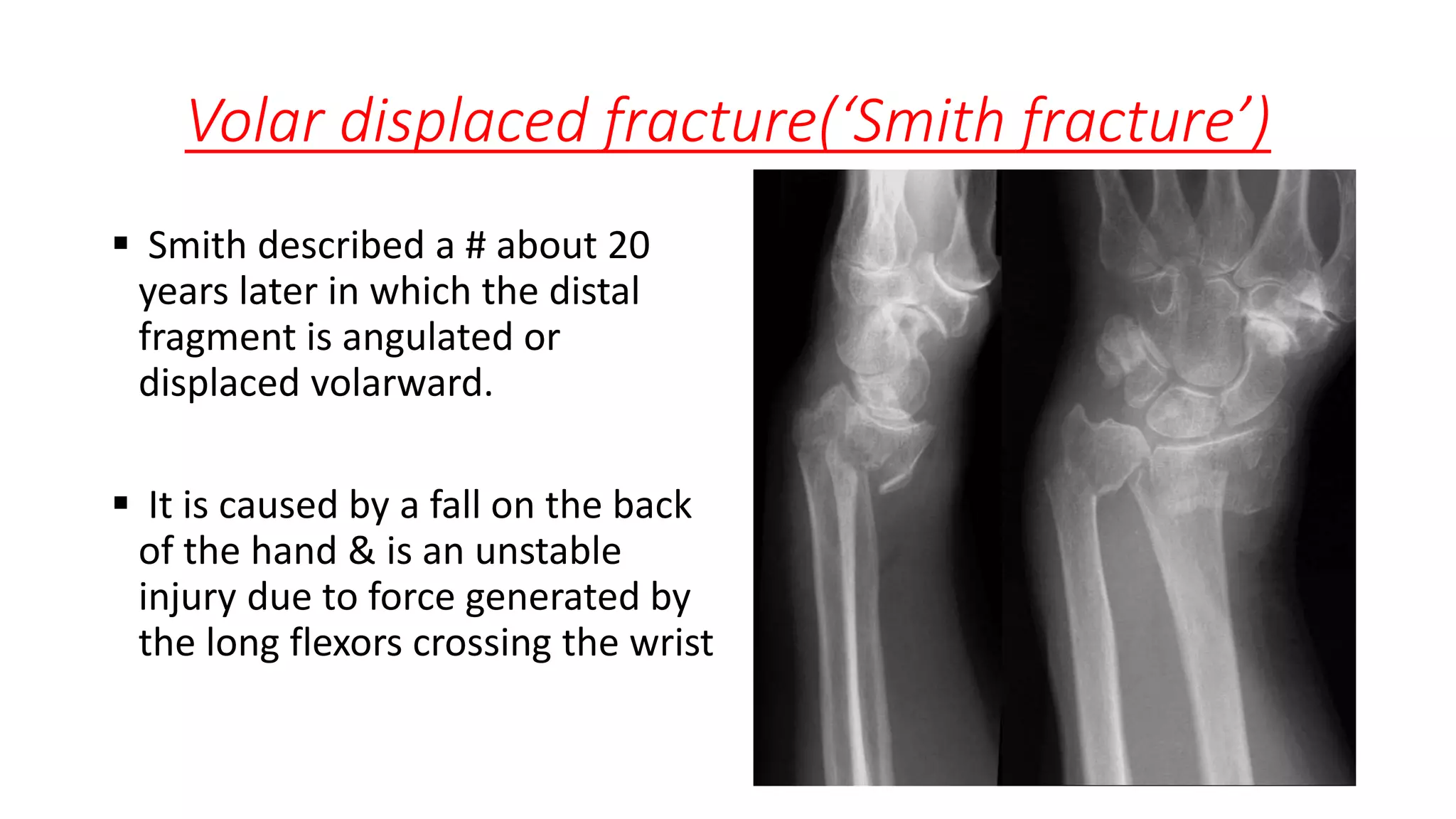 Volar displaced fracture(‘Smith fracture’)
 Smith described a # about 20
years later in which the distal
fragment is angulated or
displaced volarward.
 It is caused by a fall on the back
of the hand & is an unstable
injury due to force generated by
the long flexors crossing the wrist
 