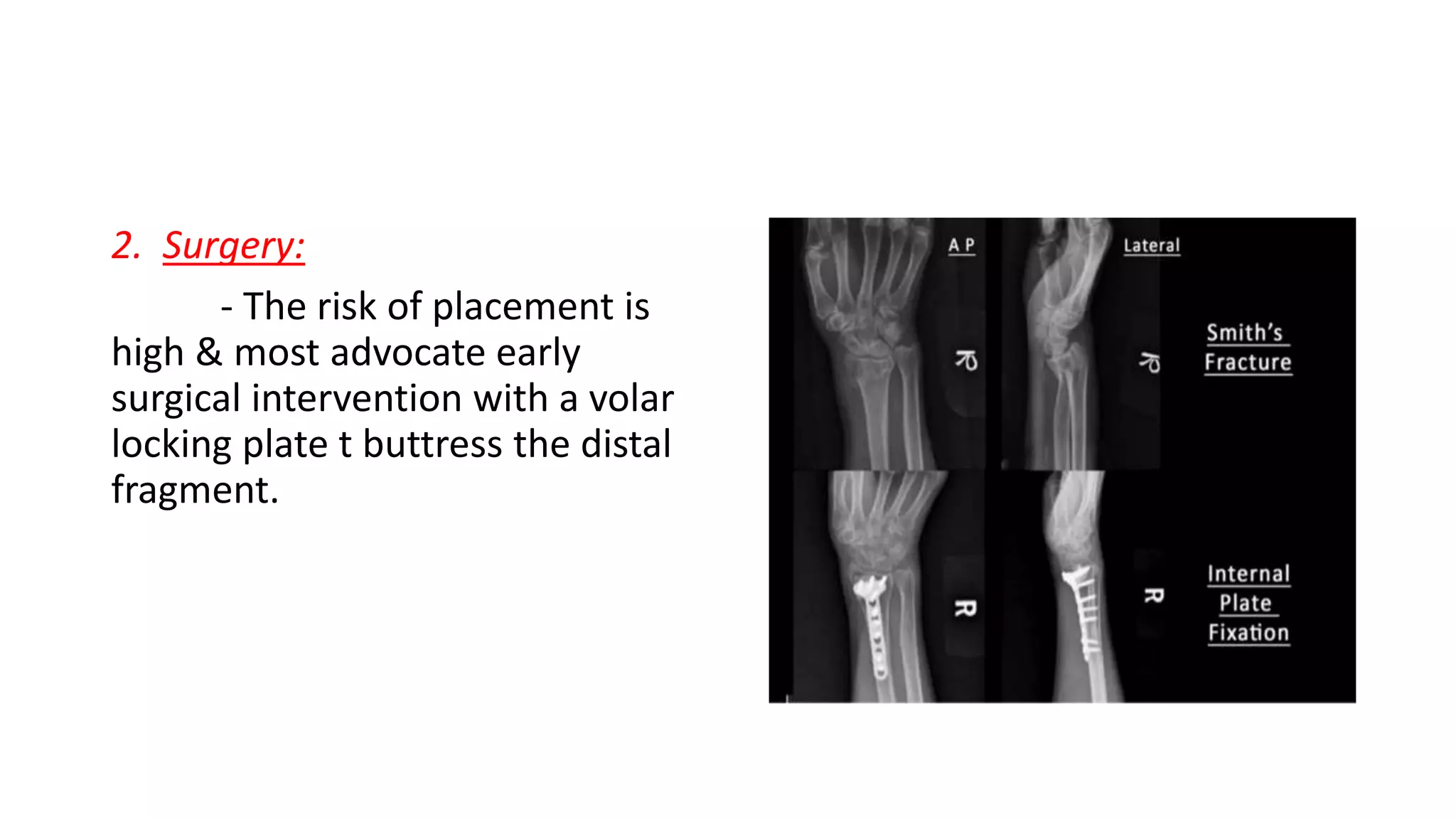 2. Surgery:
- The risk of placement is
high & most advocate early
surgical intervention with a volar
locking plate t buttress the distal
fragment.
 