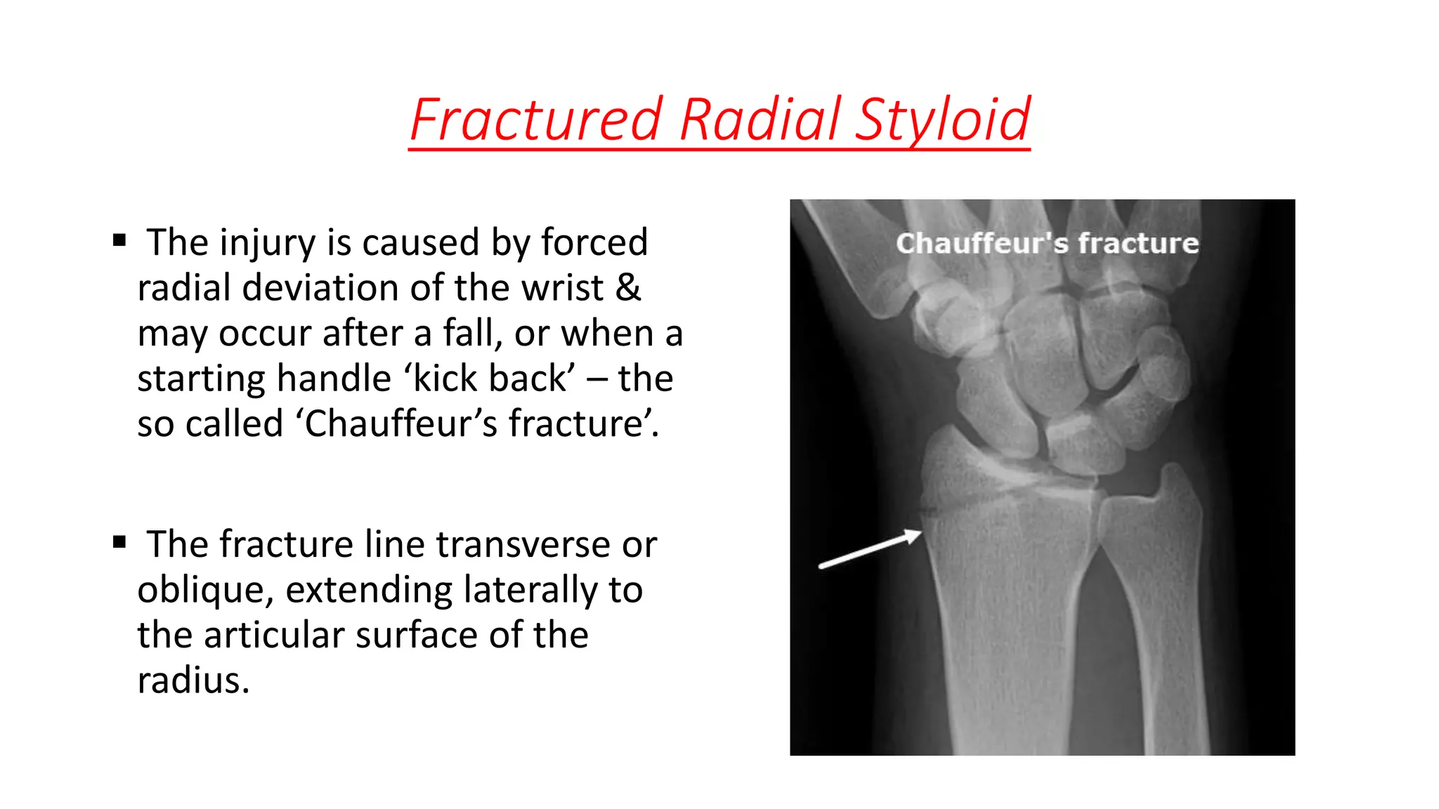 Fractured Radial Styloid
 The injury is caused by forced
radial deviation of the wrist &
may occur after a fall, or when a
starting handle ‘kick back’ – the
so called ‘Chauffeur’s fracture’.
 The fracture line transverse or
oblique, extending laterally to
the articular surface of the
radius.
 