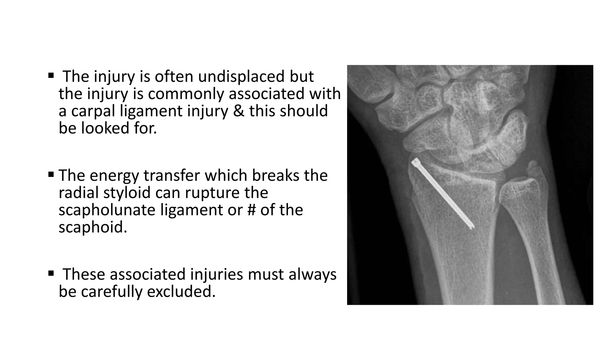  The injury is often undisplaced but
the injury is commonly associated with
a carpal ligament injury & this should
be looked for.
 The energy transfer which breaks the
radial styloid can rupture the
scapholunate ligament or # of the
scaphoid.
 These associated injuries must always
be carefully excluded.
 