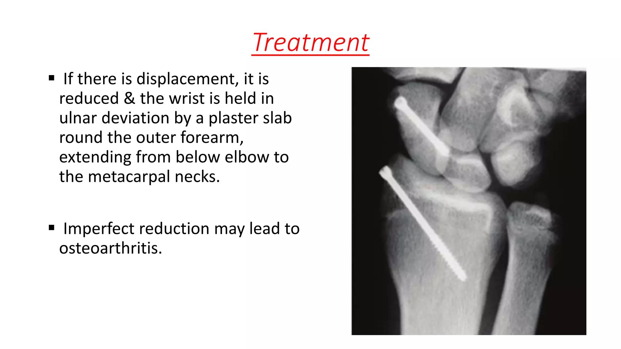 Treatment
 If there is displacement, it is
reduced & the wrist is held in
ulnar deviation by a plaster slab
round the outer forearm,
extending from below elbow to
the metacarpal necks.
 Imperfect reduction may lead to
osteoarthritis.
 