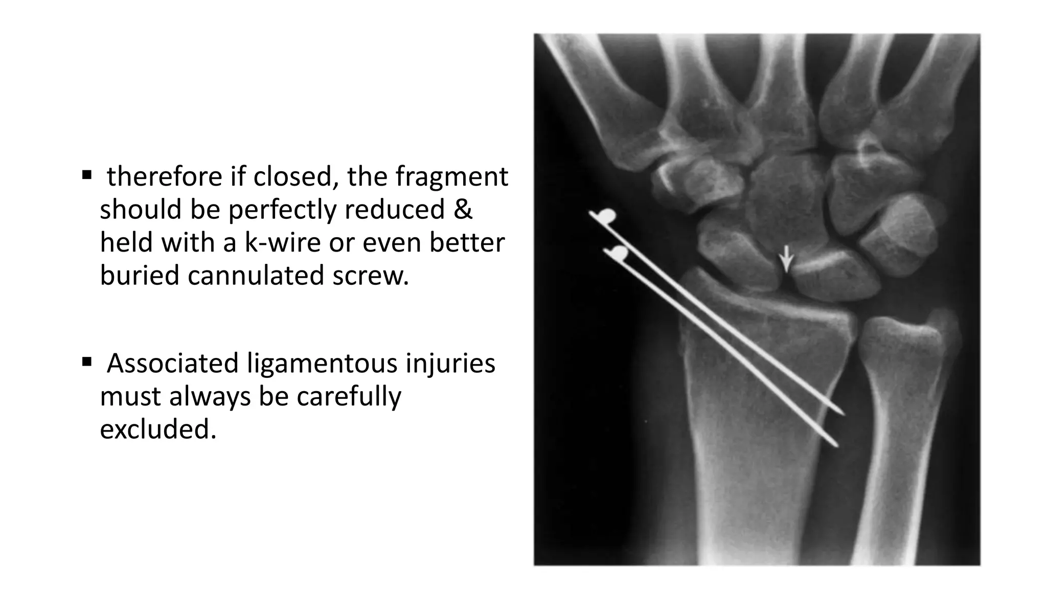  therefore if closed, the fragment
should be perfectly reduced &
held with a k-wire or even better
buried cannulated screw.
 Associated ligamentous injuries
must always be carefully
excluded.
 