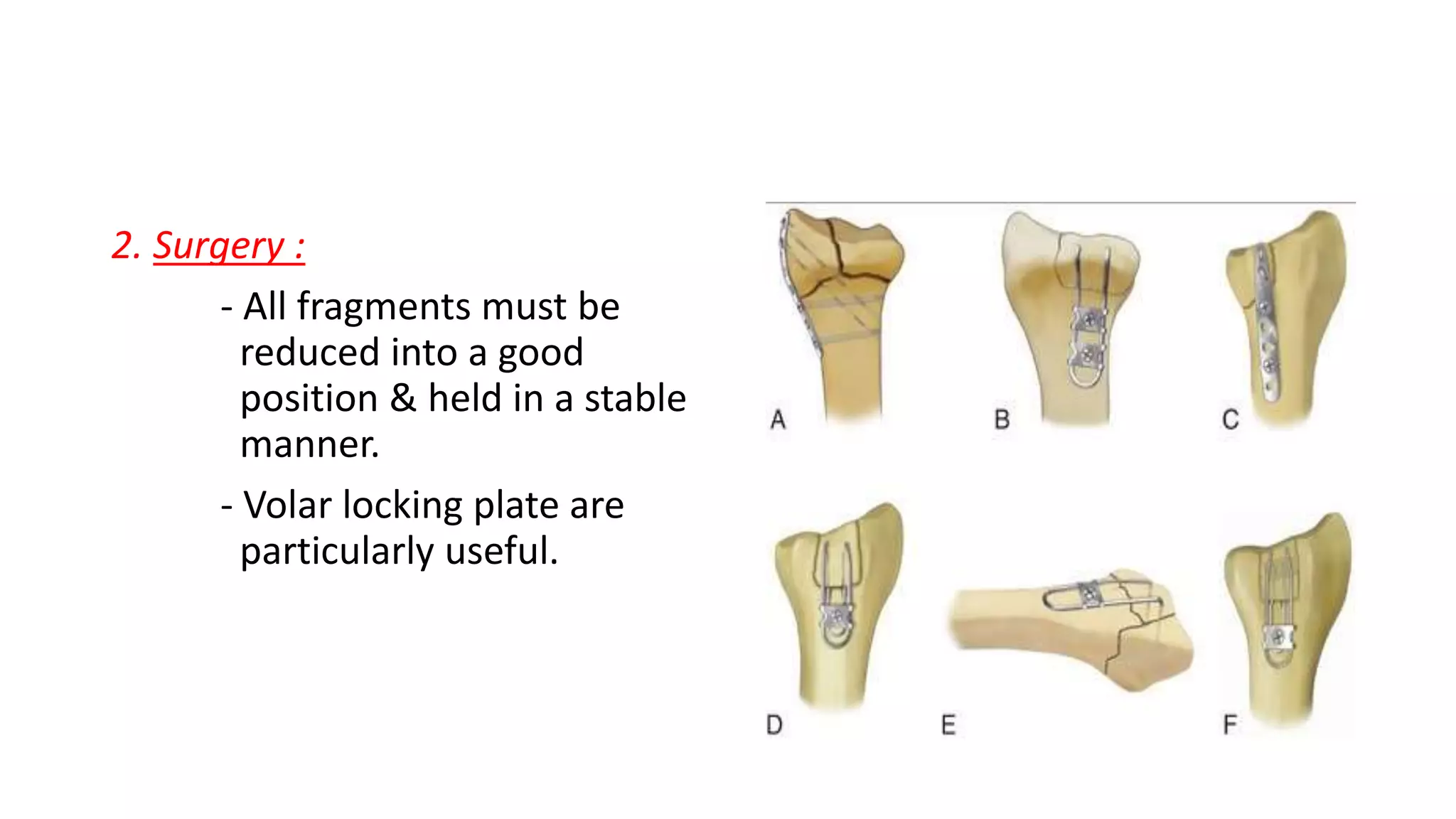2. Surgery :
- All fragments must be
reduced into a good
position & held in a stable
manner.
- Volar locking plate are
particularly useful.
 