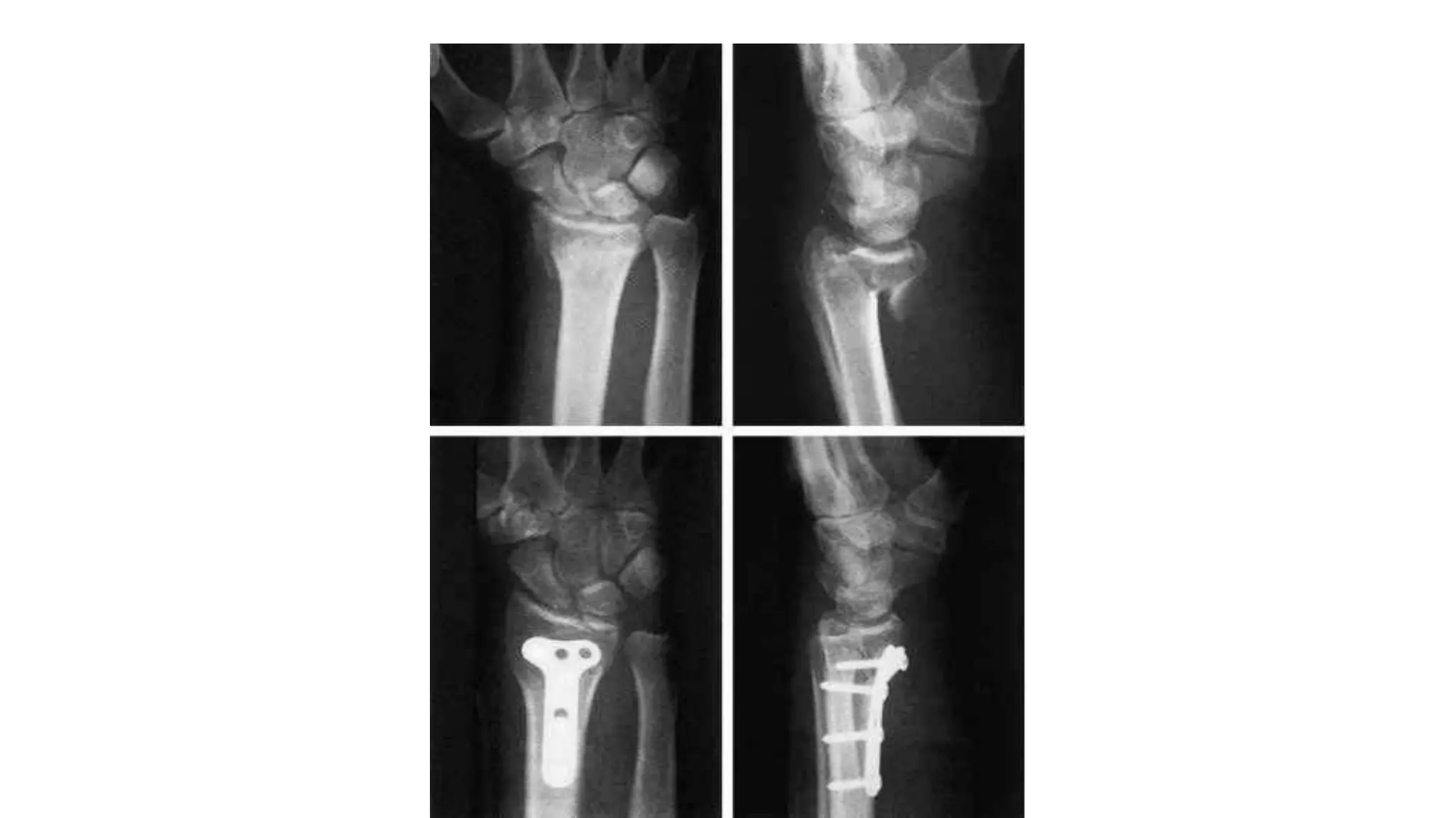 Fracture of the distal radius