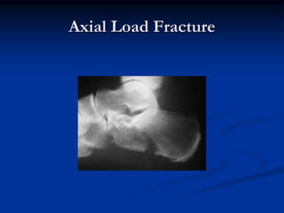 Fracture of Tibia,ankle and foot.ppt