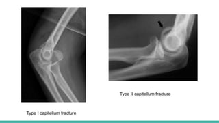 Fracture of Upper Limb Part 2 097826.pptx