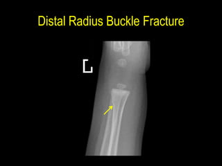 Fracture peads slides