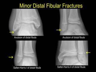 Fracture peads slides