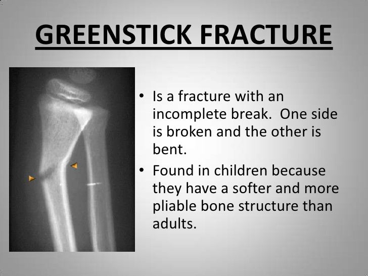 fracture definition
