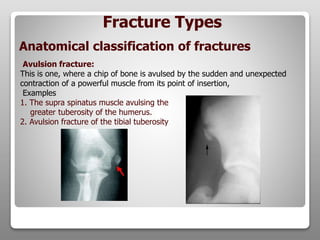 Avulsion fracture:
This is one, where a chip of bone is avulsed by the sudden and unexpected
contraction of a powerful muscle from its point of insertion,
Examples
1. The supra spinatus muscle avulsing the
greater tuberosity of the humerus.
2. Avulsion fracture of the tibial tuberosity
Fracture Types
Anatomical classification of fractures
 