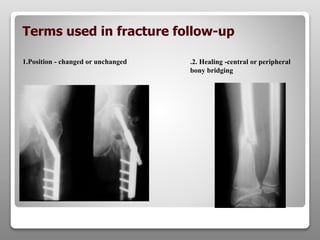 1.Position - changed or unchanged
Terms used in fracture follow-up
.2. Healing -central or peripheral
bony bridging
 