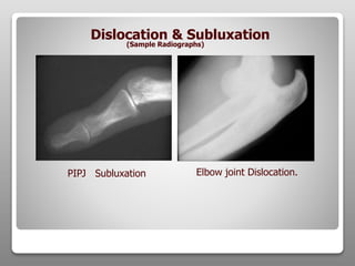 PIPJ Subluxation Elbow joint Dislocation.
Dislocation & Subluxation
(Sample Radiographs)
 