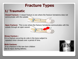 Closed fracture: A closed fracture is one where the fracture hematoma does not
communicate with the outside
Open fracture: This is one where the fracture hematoma communicates with the
outside through an open wound.
1/ Traumatic
Fracture Types
Stress fracture :
It is a fracture occurring at a site in the bone subject to
repeated minor stresses over a period of time.
Birth fracture:
It is a fracture in the new born children
due to injury during delivery.
 