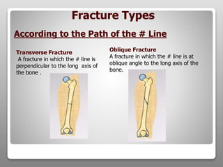 Transverse Fracture
A fracture in which the # line is
perpendicular to the long axis of
the bone .
Oblique Fracture
A fracture in which the # line is at
oblique angle to the long axis of the
bone.
According to the Path of the # Line
Fracture Types
 
