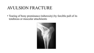 FRACTURE PPT.pptx