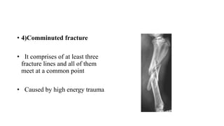 FRACTURE PPT.pptx