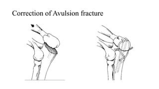 FRACTURE PPT.pptx