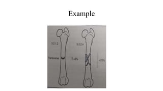 FRACTURE PPT.pptx