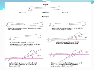 FRACTURE PPT.pptx