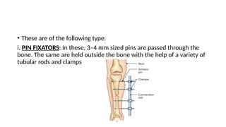 fracture ppt in general with treatment .pptx