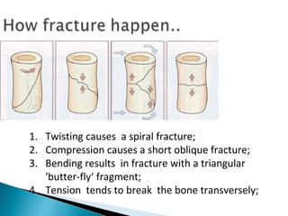 1. Twisting causes a spiral fracture;
2. Compression causes a short oblique fracture;
3. Bending results in fracture with a triangular
'butter-fly‘ fragment;
4. Tension tends to break the bone transversely;
 