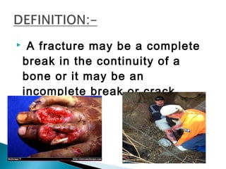  A fracture may be a complete
break in the continuity of a
bone or it may be an
incomplete break or crack.
 