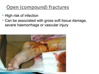  High risk of infection
 Can be associated with gross soft tissue damage,
severe haemorrhage or vascular injury
 