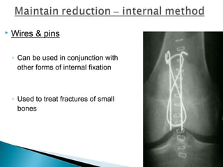  Wires & pins
◦ Can be used in conjunction with
other forms of internal fixation
◦ Used to treat fractures of small
bones
 