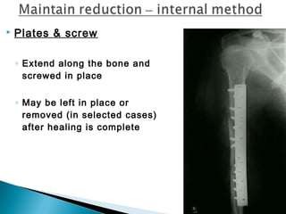  Plates & screw
◦ Extend along the bone and
screwed in place
◦ May be left in place or
removed (in selected cases)
after healing is complete
 