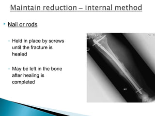  Nail or rods
◦ Held in place by screws
until the fracture is
healed
◦ May be left in the bone
after healing is
completed
 