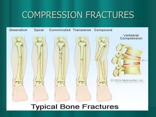 COMPRESSION FRACTURES
 