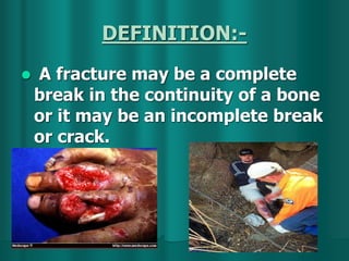 DEFINITION:-
 A fracture may be a complete
break in the continuity of a bone
or it may be an incomplete break
or crack.
 