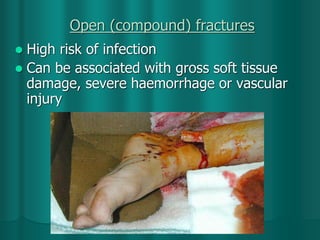 Open (compound) fractures
 High risk of infection
 Can be associated with gross soft tissue
damage, severe haemorrhage or vascular
injury
 