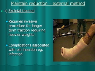 Maintain reduction – external method
 4) Skeletal traction
 Requires invasive
procedure for longer
term traction requiring
heavier weights
 Complications associated
with pin insertion eg.
infection
 