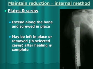 Maintain reduction – internal method
 Plates & screw
 Extend along the bone
and screwed in place
 May be left in place or
removed (in selected
cases) after healing is
complete
 